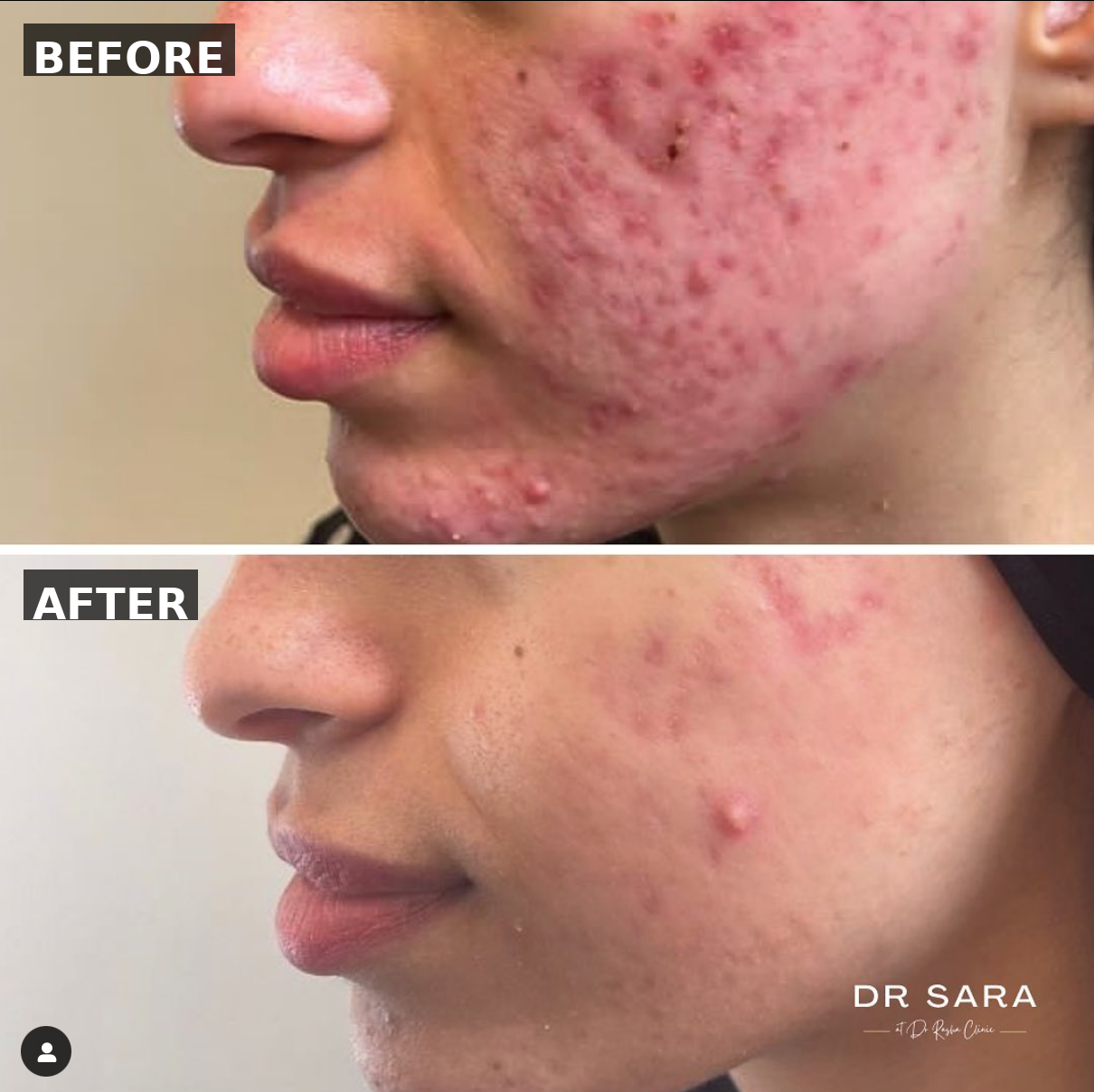 Before - NeoGen — Acne Scar