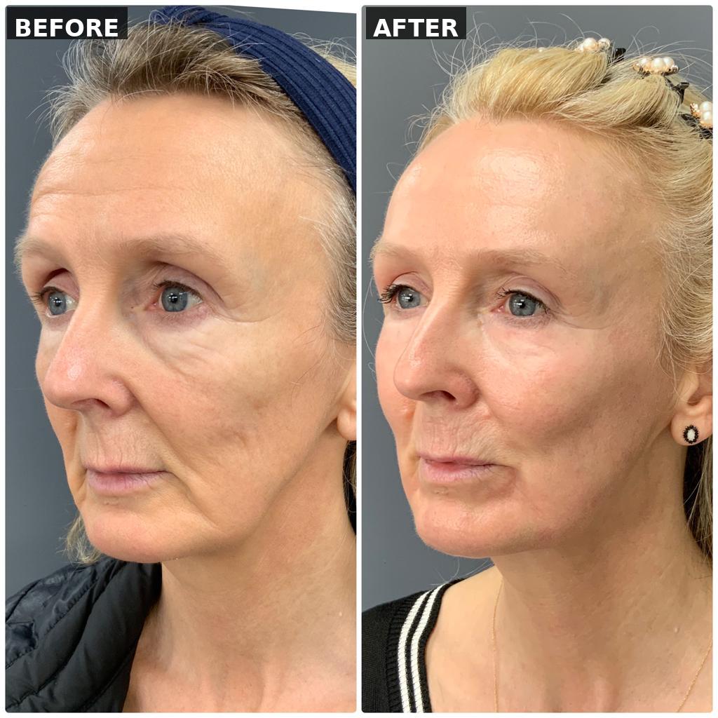 After - NeoGen — Acne Scar