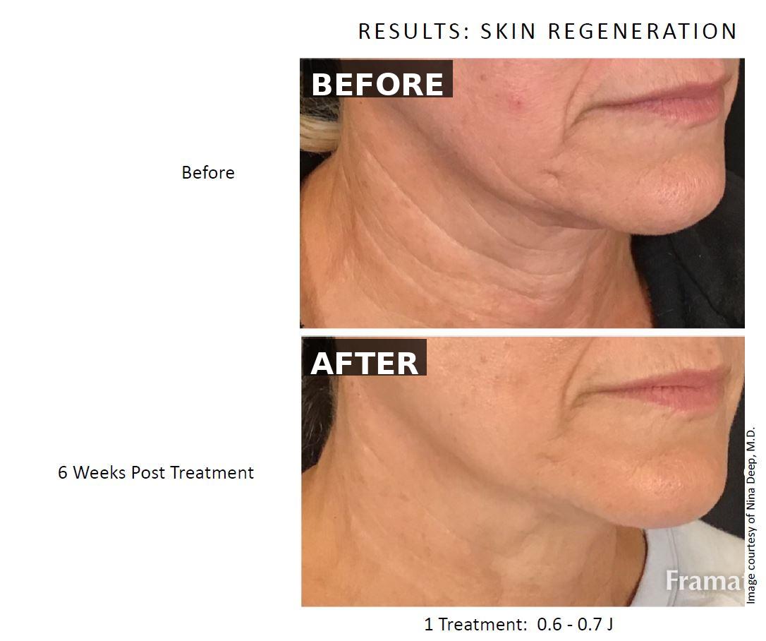 Before - NeoGen — Facial Regeneration