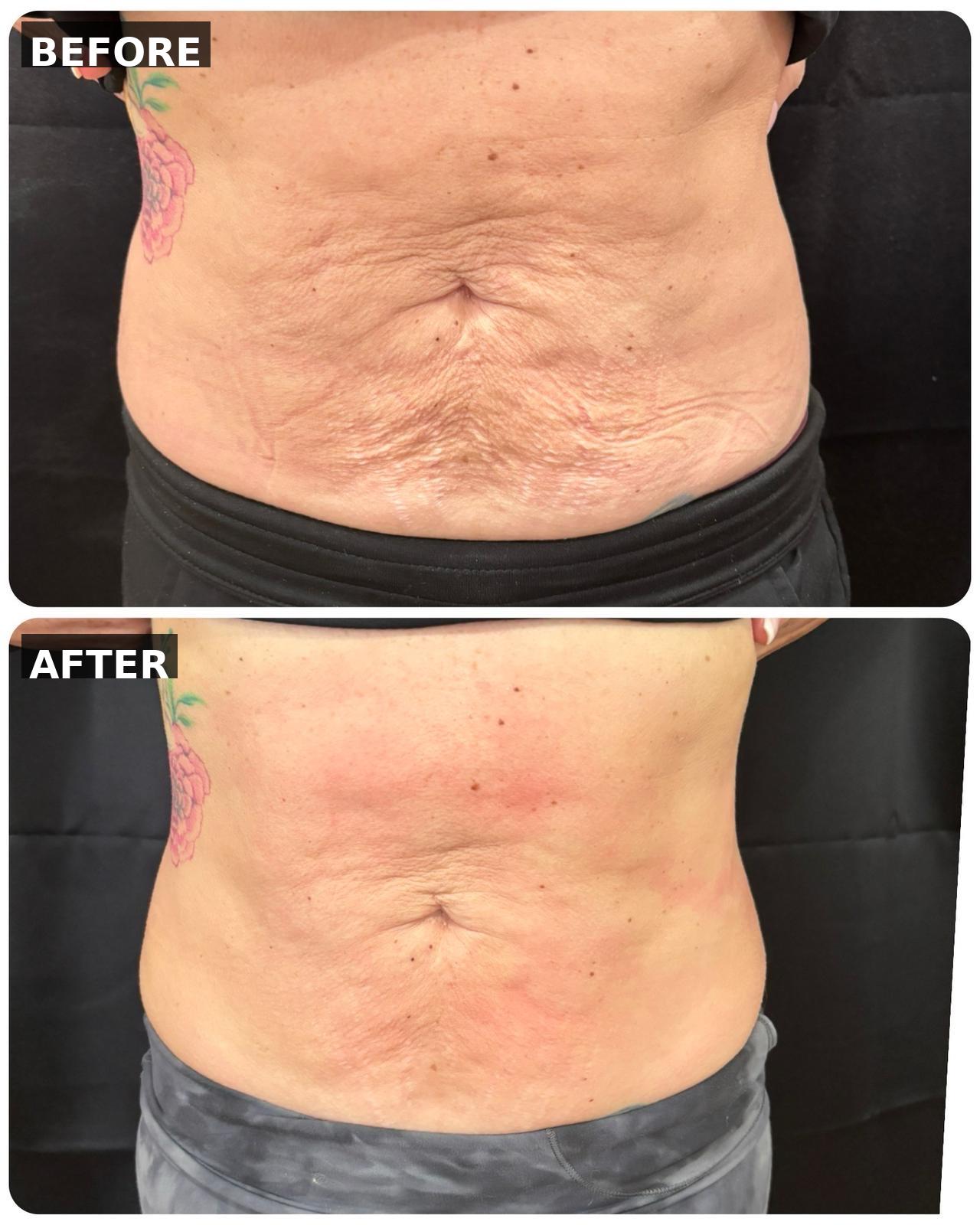Before - ARTEMIS T2 — Body Tightening