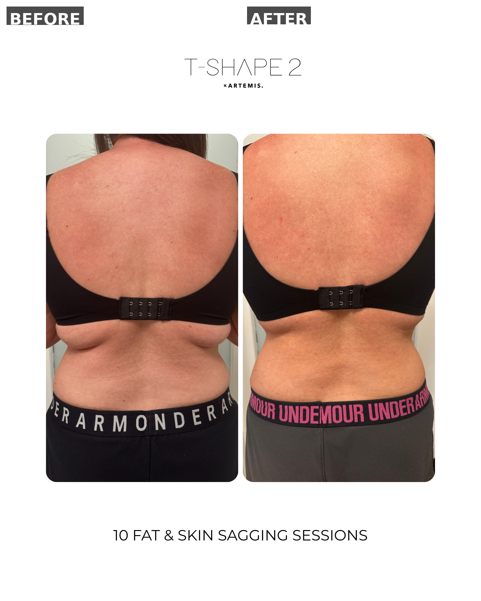 After - ARTEMIS T2 — Body Tightening
