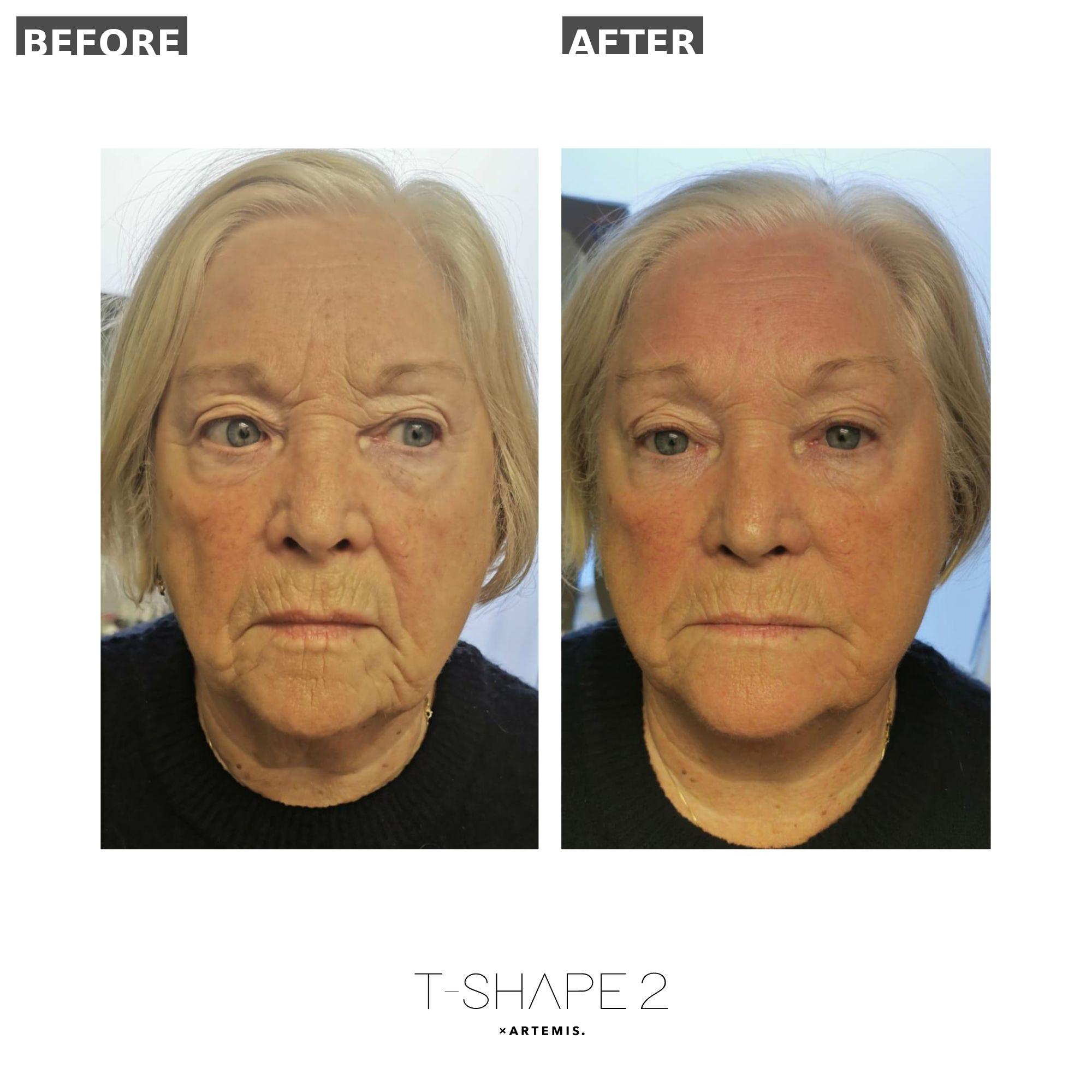 After - NeoGen — Facial Regeneration