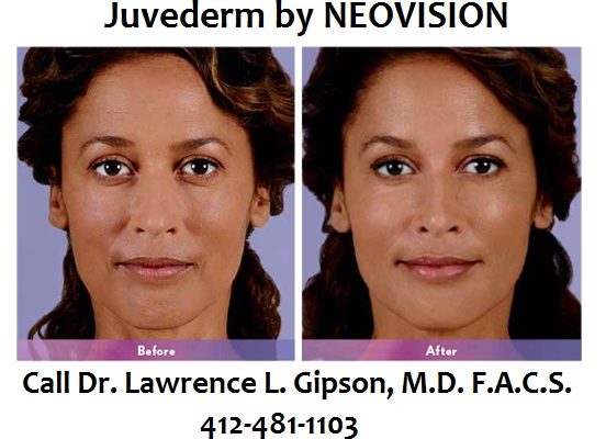 Juvederm