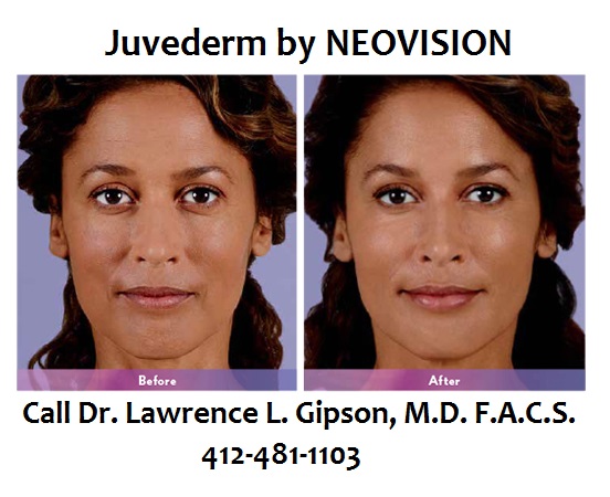 Juvederm