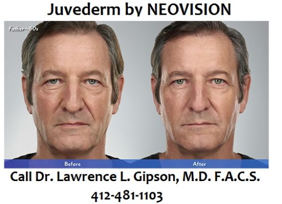 Juvederm