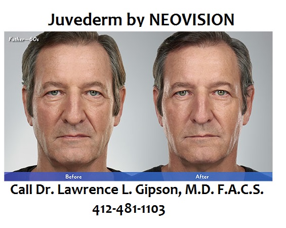 Juvederm