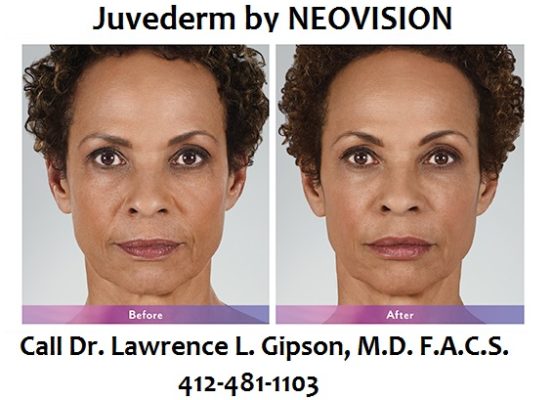 Juvederm