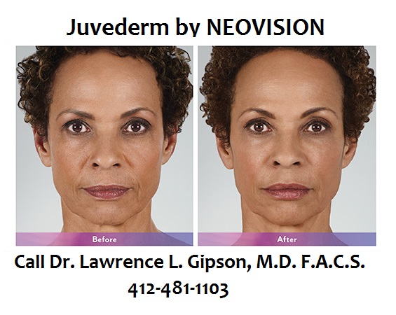 Juvederm