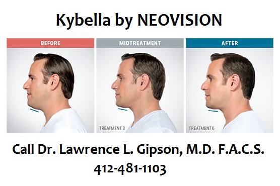 Kybella