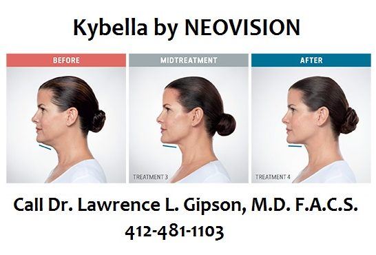 Kybella