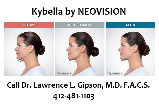 Kybella