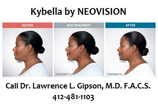 Kybella