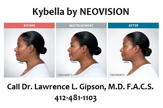 Kybella