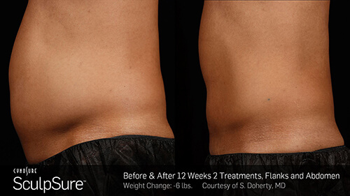 SculpSure Before and After