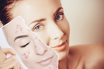 Woman With Clear Skin Showing a Picture of Herself With Acne