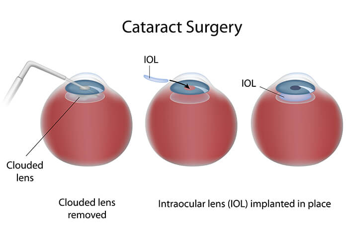 Chart Illustrating the Steps of Cataract Surgery