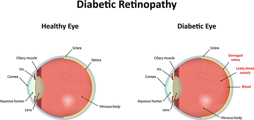 Chart Illustrating how Diabetic Retinopathy Affects the Eye