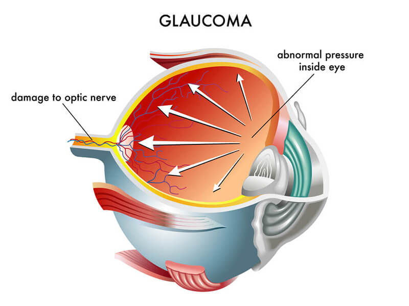 Chart Illustration How Glaucoma Affects an Eye