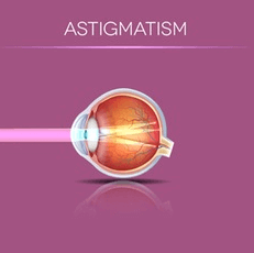 Illustration of How Light Enters an Eye With Astigmatism