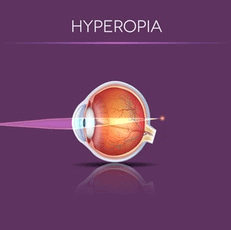 Illustration of How Light Enters an Eye With Hyperopia