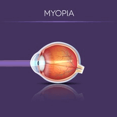 Illustration Showing How Light Enters an Eye With Myopia