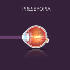 Illustration of How Light Enters an Eye With Presbyopia