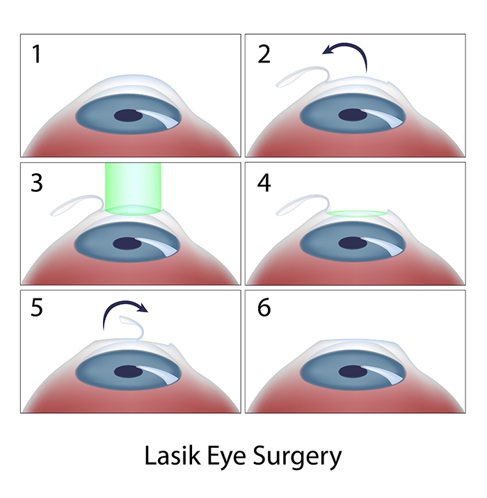 Chart Illustrating the Steps of LASIK Surgery