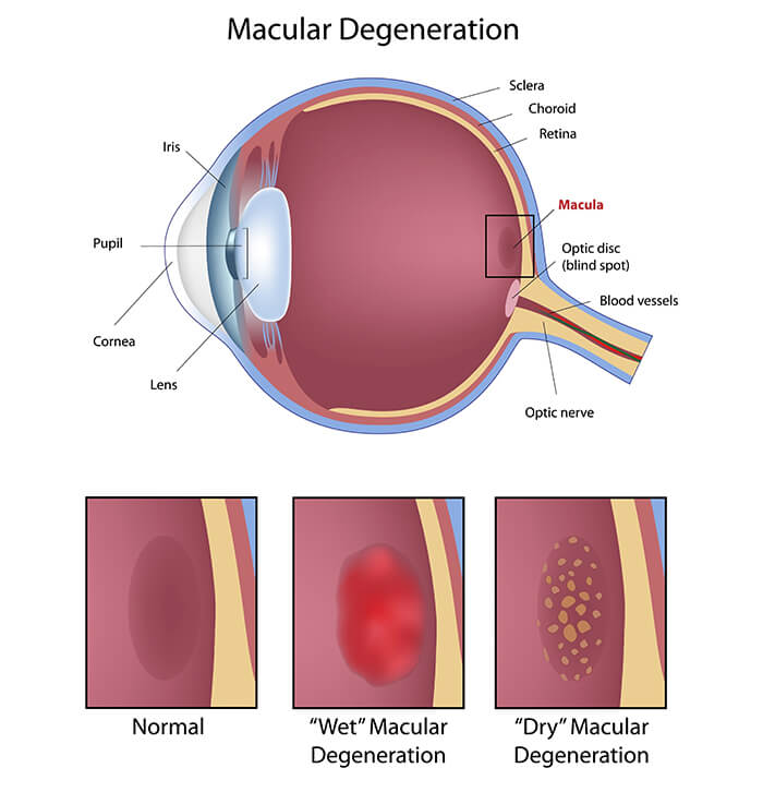 Macular Degeneration Chart