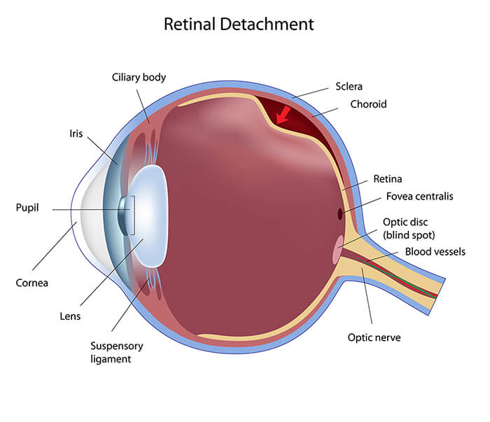 Chart Illustrating a Retinal Detachment in the Eye