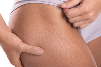 Woman Showing Stretch Marks on Her Leg